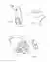 Fig. 15 - Irrigation and aspiration device and method