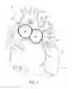 Fig. 02 - Ventricular assist device