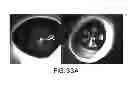 Fig. 45 - APPARATUS, DEVICES AND METHODS FOR OBTAINING OMNIDIRECTIONAL VIEWING BY A CATHETER