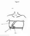 Fig. 09 - Breast wrap