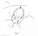 Fig. 04 - UNDERGARMENT WITH REMOVABLE LINER
