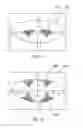 Fig. 34 - Methods and systems to provide excluded defined zones for increasing accommodative amplitude