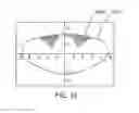 Fig. 35 - Methods and systems to provide excluded defined zones for increasing accommodative amplitude