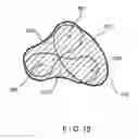 Fig. 16 - Methods of sterilization and treating infection using irreversible electroporation