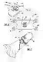 Fig. 04 - Locking mechanism to secure ends of an implantable band