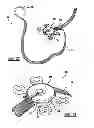 Fig. 11 - Locking mechanism to secure ends of an implantable band