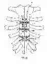 Fig. 12 - Locking mechanism to secure ends of an implantable band