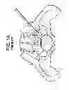 Fig. 02 - Cortical Rim-Supporting Interbody Device