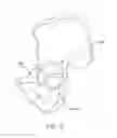 Fig. 06 - Method and apparatus for distracting a joint, including the provision and use of a novel fluid joint spacer
