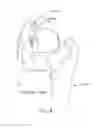 Fig. 09 - Method and apparatus for distracting a joint, including the provision and use of a novel fluid joint spacer