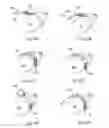 Fig. 09 - Device and method for hip distention and access