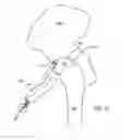 Fig. 13 - Device and method for hip distention and access