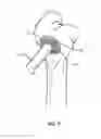 Fig. 06 - Anchored cannula