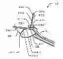 Fig. 01 - SUPPORTED RETRIEVAL DEVICE AND RELATED METHODS OF USE