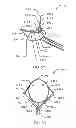 Fig. 06 - SUPPORTED RETRIEVAL DEVICE AND RELATED METHODS OF USE