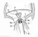 Fig. 01 - Apparatus and method for heart valve repair