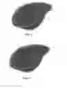 Fig. 02 - Implantable hernia prosthesis with an uninterrupted ring
