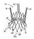 Fig. 01 - Sinus-engaging valve fixation member