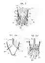 Fig. 02 - Sinus-engaging valve fixation member