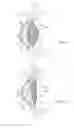 Fig. 02 - Accommodating intraocular lens having dual shape memory optical elements