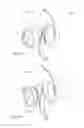 Fig. 16 - Accommodating intraocular lens having dual shape memory optical elements