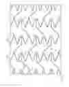 Fig. 03 - Stent with deflecting connector