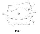 Fig. 02 - REVERSE CAGE INTERVERTEBRAL FUSION IMPLANTS