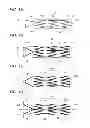 Fig. 02 - Biliary stent