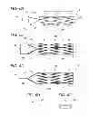 Fig. 06 - Biliary stent