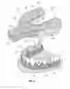 Fig. 07 - Dental retention systems