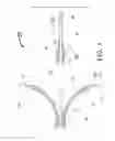 Fig. 02 - Peri-vascular tissue ablation catheter with deflection surface support structures