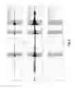 Fig. 09 - Reduction of transient sounds in hearing implants