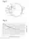 Fig. 02 - Intraocular lens