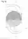 Fig. 11 - Intraocular lens
