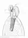 Fig. 01 - Dental post for supporting dental prostheses and method for the production thereof