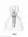 Fig. 02 - Dental post for supporting dental prostheses and method for the production thereof