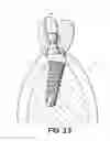 Fig. 06 - Dental post for supporting dental prostheses and method for the production thereof