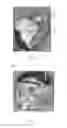 Fig. 07 - Hearing aid with inductively coupled electromagnetic resonator antenna
