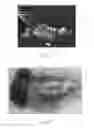 Fig. 08 - Hearing aid with inductively coupled electromagnetic resonator antenna