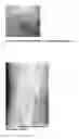 Fig. 06 - DEVICES, COMPOSITIONS AND METHODS FOR TREATING ACUTE AND CHRONIC TISSUE DAMAGE