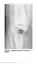 Fig. 07 - DEVICES, COMPOSITIONS AND METHODS FOR TREATING ACUTE AND CHRONIC TISSUE DAMAGE
