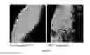 Fig. 16 - Method of treating food allergies by administering a nanoparticle comprising heparin and chitosan encapsulating IL-12