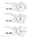 Fig. 43 - Apparatus for performing vascular anastomosis