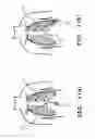 Fig. 02 - Needle for physically separating and penetrating the pericardium