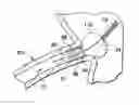 Fig. 01 - Stent delivery under direct visualization