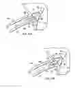 Fig. 09 - Stent delivery under direct visualization