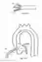 Fig. 13 - Stent delivery under direct visualization