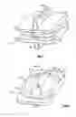 Fig. 02 - Transforaminal prosthetic spinal disc apparatus