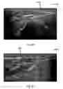 Fig. 24 - Depth Advancement Marker Needle For Image Guided Procedures
