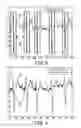 Fig. 05 - Determining onsets and offsets of cardiac depolarization and repolarization waves